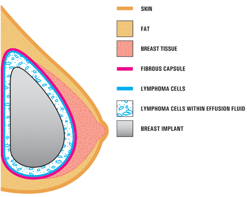 Anaplastic Large Cell Lymphoma (ALCL) Image