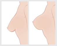 Cartoon image of before and after breast augmentation