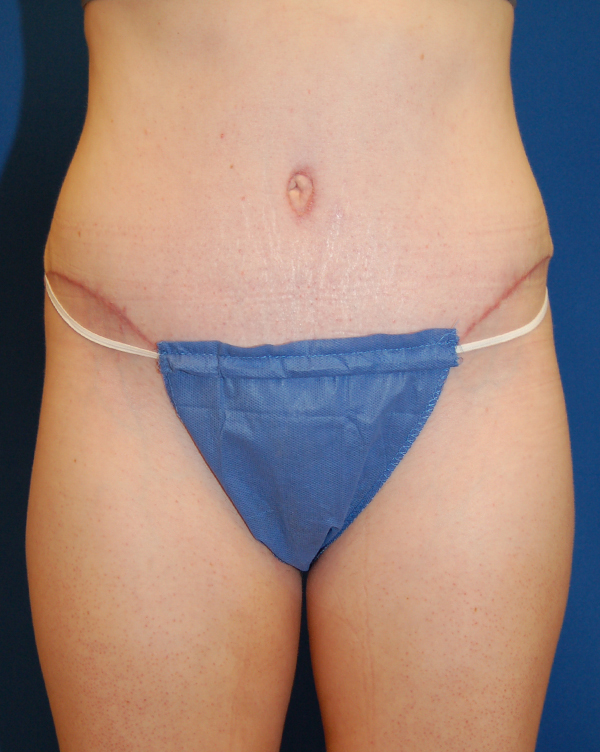 Abdominoplasty Before and After | Brzowski Plastic Surgery