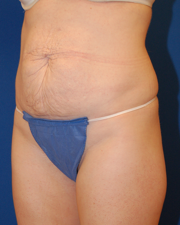 Abdominoplasty Before and After | Brzowski Plastic Surgery