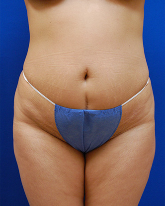 Abdominoplasty Before and After | Brzowski Plastic Surgery