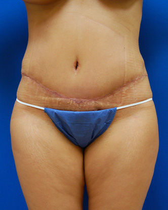 Abdominoplasty Before and After | Brzowski Plastic Surgery