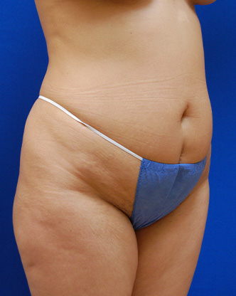 Abdominoplasty Before and After | Brzowski Plastic Surgery