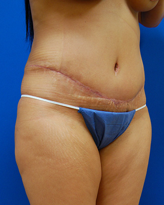 Abdominoplasty Before and After | Brzowski Plastic Surgery