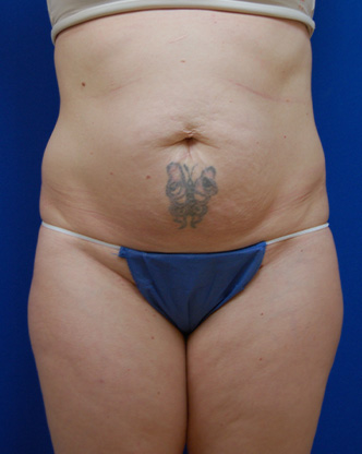 Abdominoplasty Before and After | Brzowski Plastic Surgery