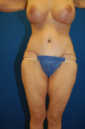 Abdominoplasty Before and After | Brzowski Plastic Surgery