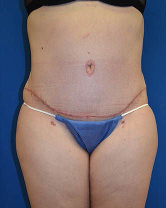 Abdominoplasty Before and After | Brzowski Plastic Surgery