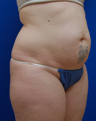 Abdominoplasty Before and After | Brzowski Plastic Surgery