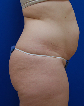 Abdominoplasty Before and After | Brzowski Plastic Surgery