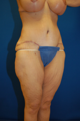 Abdominoplasty Before and After | Brzowski Plastic Surgery