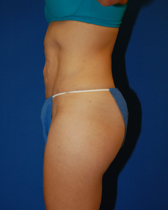 Abdominoplasty Before and After | Brzowski Plastic Surgery