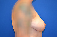 Breast Augmentation Before and After | Brzowski Plastic Surgery