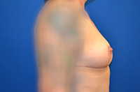 Breast Augmentation Before and After | Brzowski Plastic Surgery