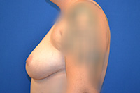 Breast Augmentation Before and After | Brzowski Plastic Surgery