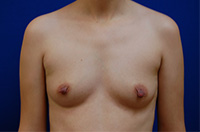 Breast Augmentation Utah