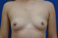 Breast Augmentation Before and After | Brzowski Plastic Surgery