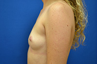 Breast Augmentation Before and After | Brzowski Plastic Surgery