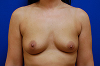 Breast Augmentation Before and After | Brzowski Plastic Surgery