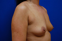 Breast Augmentation Before and After | Brzowski Plastic Surgery