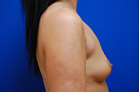 Breast Augmentation Before and After | Brzowski Plastic Surgery