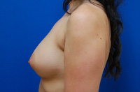 Breast Augmentation Before and After | Brzowski Plastic Surgery