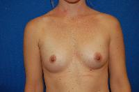 Breast Augmentation Before and After | Brzowski Plastic Surgery