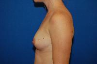 Breast Augmentation Before and After | Brzowski Plastic Surgery