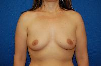 Breast Augmentation Before and After | Brzowski Plastic Surgery