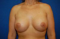 Breast Augmentation Before and After | Brzowski Plastic Surgery