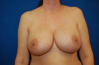 Breast Augmentation Before and After | Brzowski Plastic Surgery