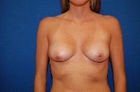 Breast Augmentation Before and After | Brzowski Plastic Surgery