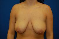 Breast Augmentation Before and After | Brzowski Plastic Surgery