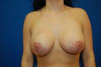 Breast Augmentation Before and After | Brzowski Plastic Surgery