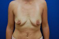 Breast Augmentation Before and After | Brzowski Plastic Surgery