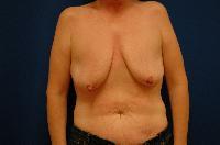 Breast Augmentation Before and After | Brzowski Plastic Surgery