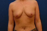 Breast Augmentation Before and After | Brzowski Plastic Surgery