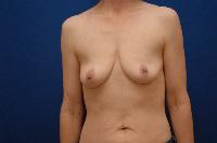 Breast Augmentation Before and After | Brzowski Plastic Surgery