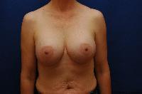 Breast Augmentation Before and After | Brzowski Plastic Surgery