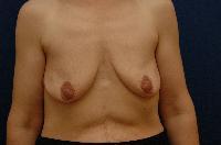 Breast Augmentation Before and After | Brzowski Plastic Surgery