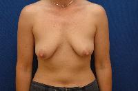 Breast Augmentation Before and After | Brzowski Plastic Surgery