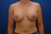 Breast Augmentation Before and After | Brzowski Plastic Surgery