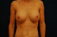 Breast Augmentation Before and After | Brzowski Plastic Surgery