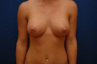 Breast Augmentation Before and After | Brzowski Plastic Surgery