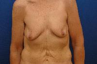 Breast Augmentation Before and After | Brzowski Plastic Surgery