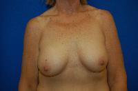 Breast Augmentation Before and After | Brzowski Plastic Surgery