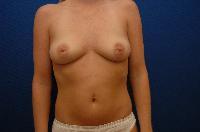 Breast Augmentation Before and After | Brzowski Plastic Surgery