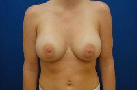 Breast Augmentation Before and After | Brzowski Plastic Surgery