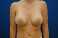 Breast Augmentation Before and After | Brzowski Plastic Surgery