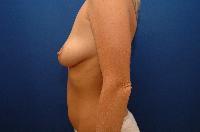 Breast Augmentation Before and After | Brzowski Plastic Surgery