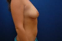 Breast Augmentation Before and After | Brzowski Plastic Surgery